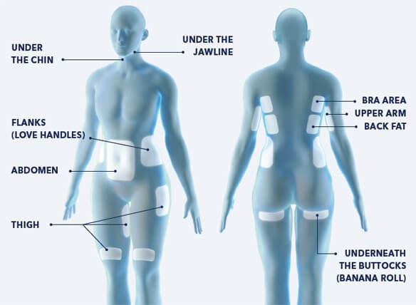 CoolSculpting Areas