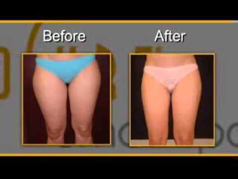 Smartlipo Laser Liposuction