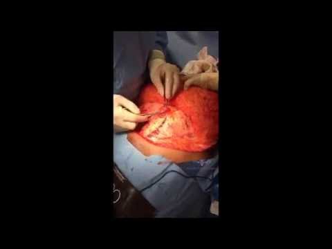 Tummy Tuck & Hernia Repair Surgery