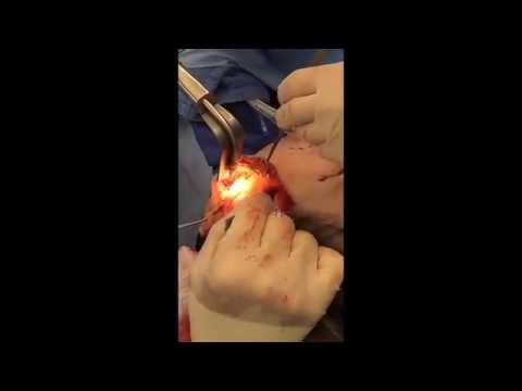 Facelift Surgery